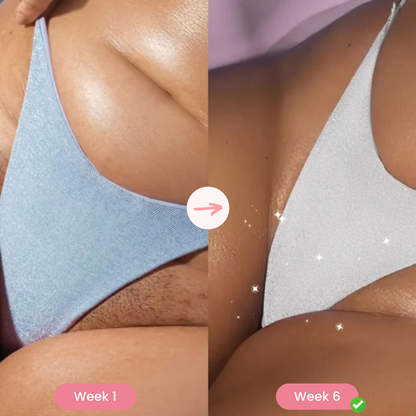 LumiPro® IPL Hair Removal
